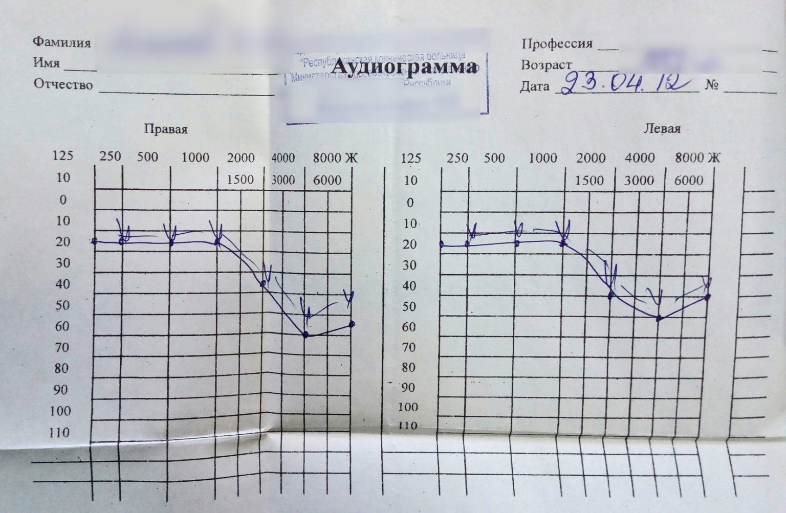 Аудиограмма слуха